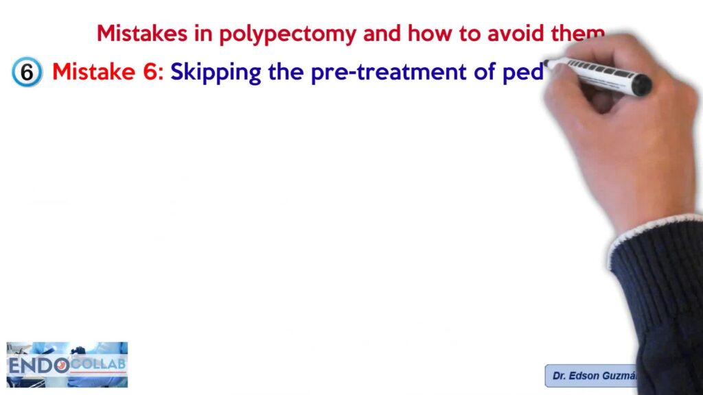 Mistakes In Polypectomy And How To Avoid Them By Dr Edson Guzman Calderon 3 Mistakes In Polypectomy And How To Avoid Them By Dr Edson Guzman Calderon