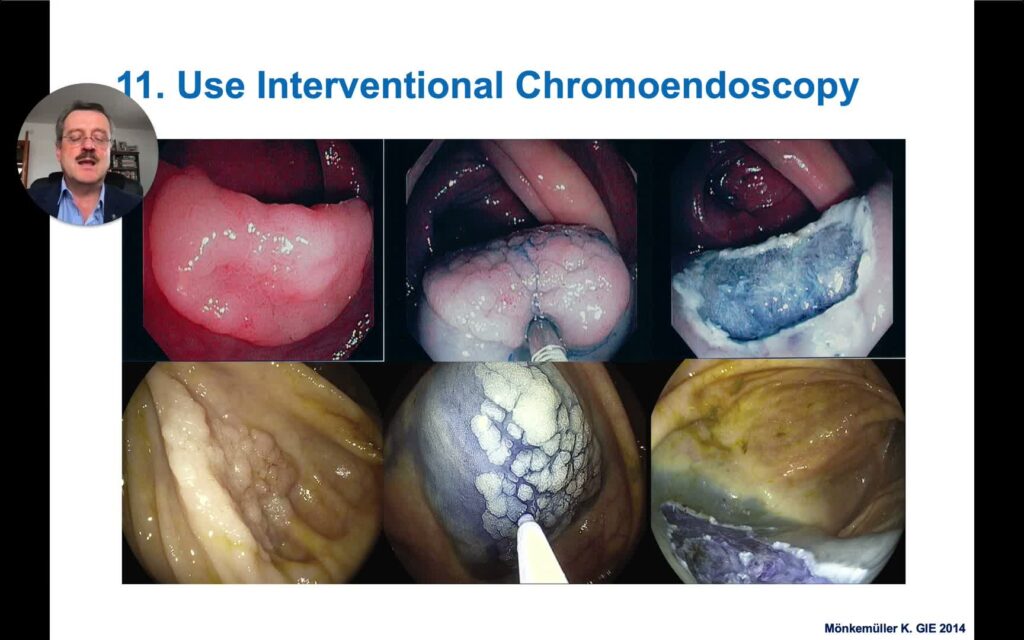 Colon Polypectomy State-Of-The-Art Ii - Endoscopic Submucosal Dissection, Fundamental Principles (Part I) 7 Colon Polypectomy State-Of-The-Art Ii – Endoscopic Submucosal Dissection, Fundamental Principles (Part I)