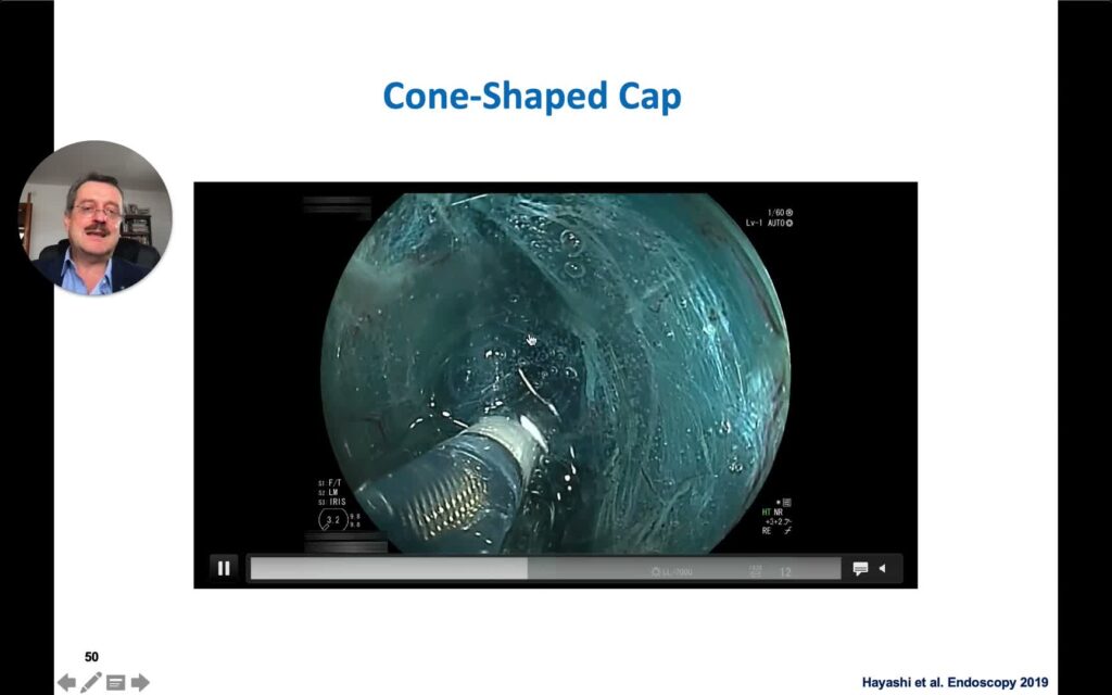 Colon Polypectomy State-of-The-Art II – Endoscopic Submucosal Dissection (Part II)