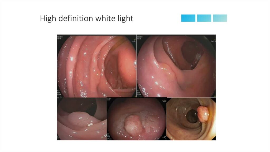 Colorectal Polyp Detection 1