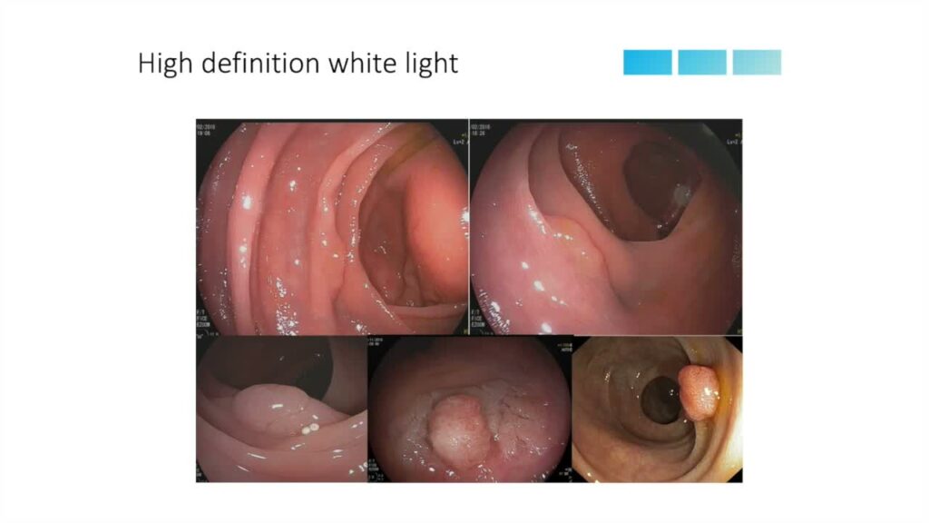 Colorectal Polyp Detection – A Practical Approach