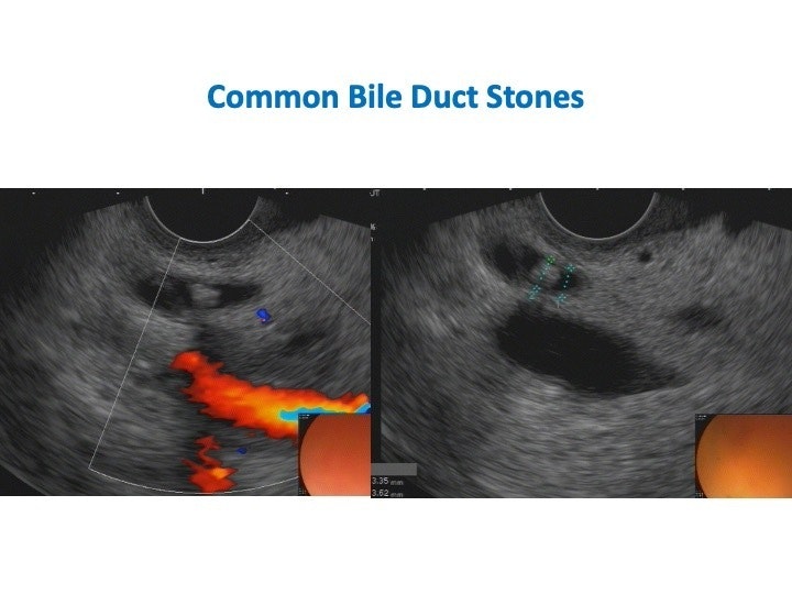 Common Bile Duct Stones 19 Common Bile Duct Stones