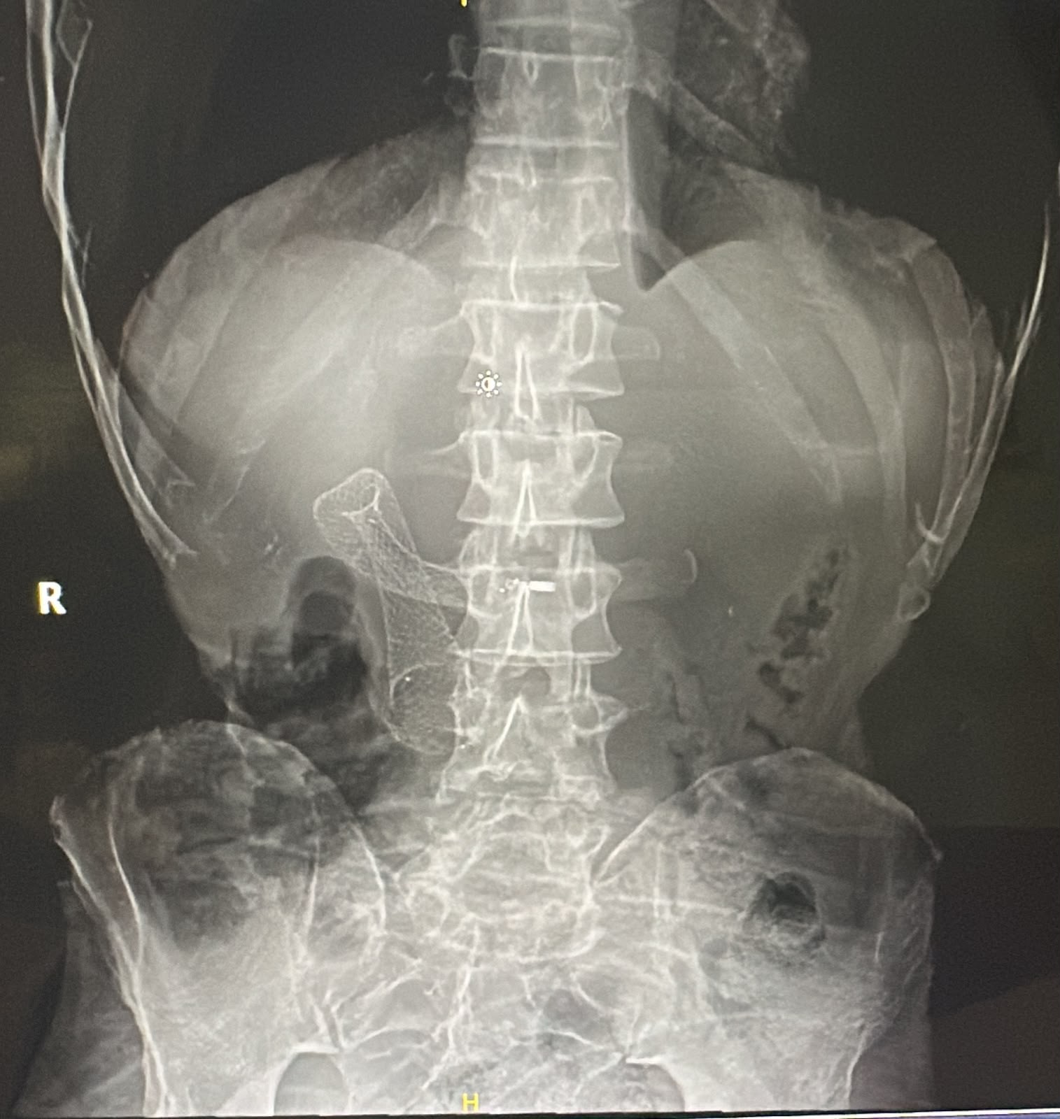 Abdominal Film Showing A Kinked Gastroduodenal Metal Stent To The Right Of The Spine