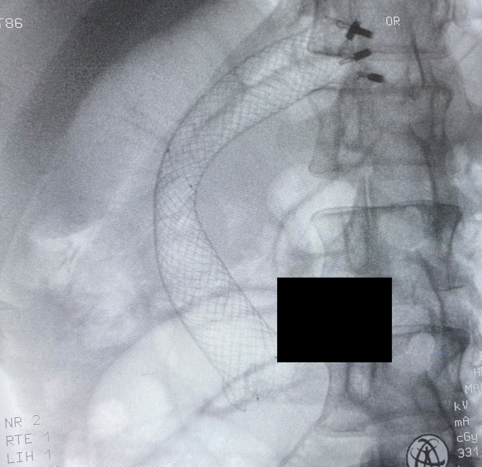 Fluoroscopy Of The Gastroduodenal Stent After Reposition, Balloon Dilation, And Clips