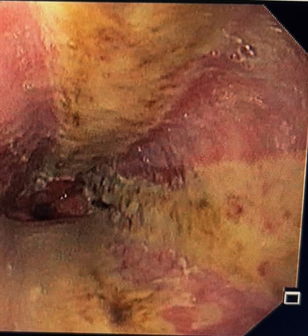 Endoscopic View Of Severe Circumferential Esophagitis With Exudate And Spared Mucosal Islands
