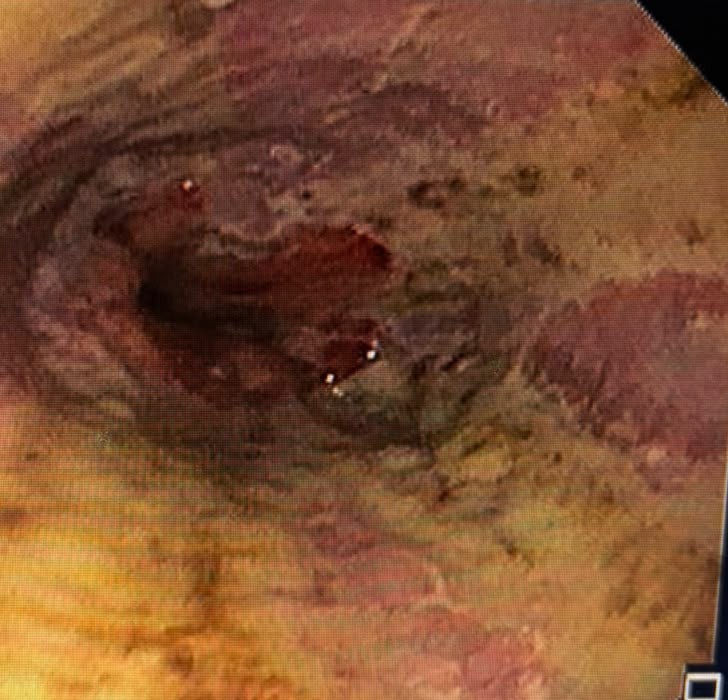 Endoscopic View Of Darker Distal Esophageal Mucosa On The Black-Esophagus Spectrum
