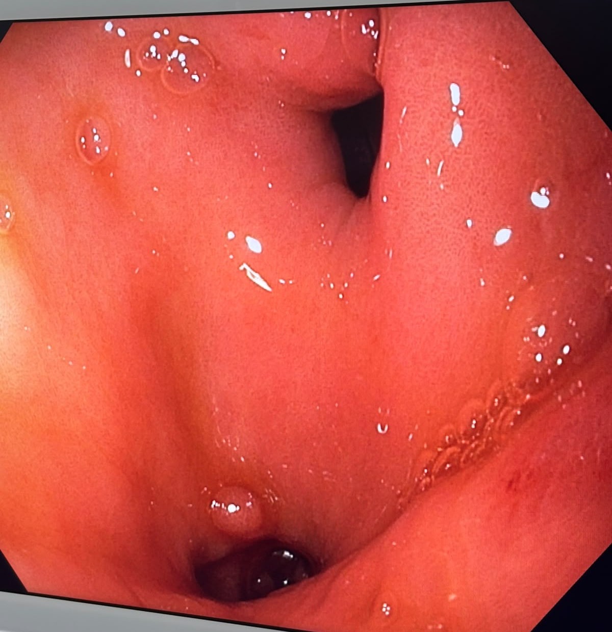Gi Endoscopy Community &Amp; Education - Endocollab