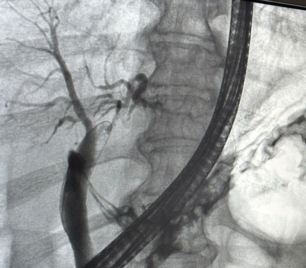 Ercp Fluoroscopy With An Endoscope In Place And Contrast In The Biliary Tree