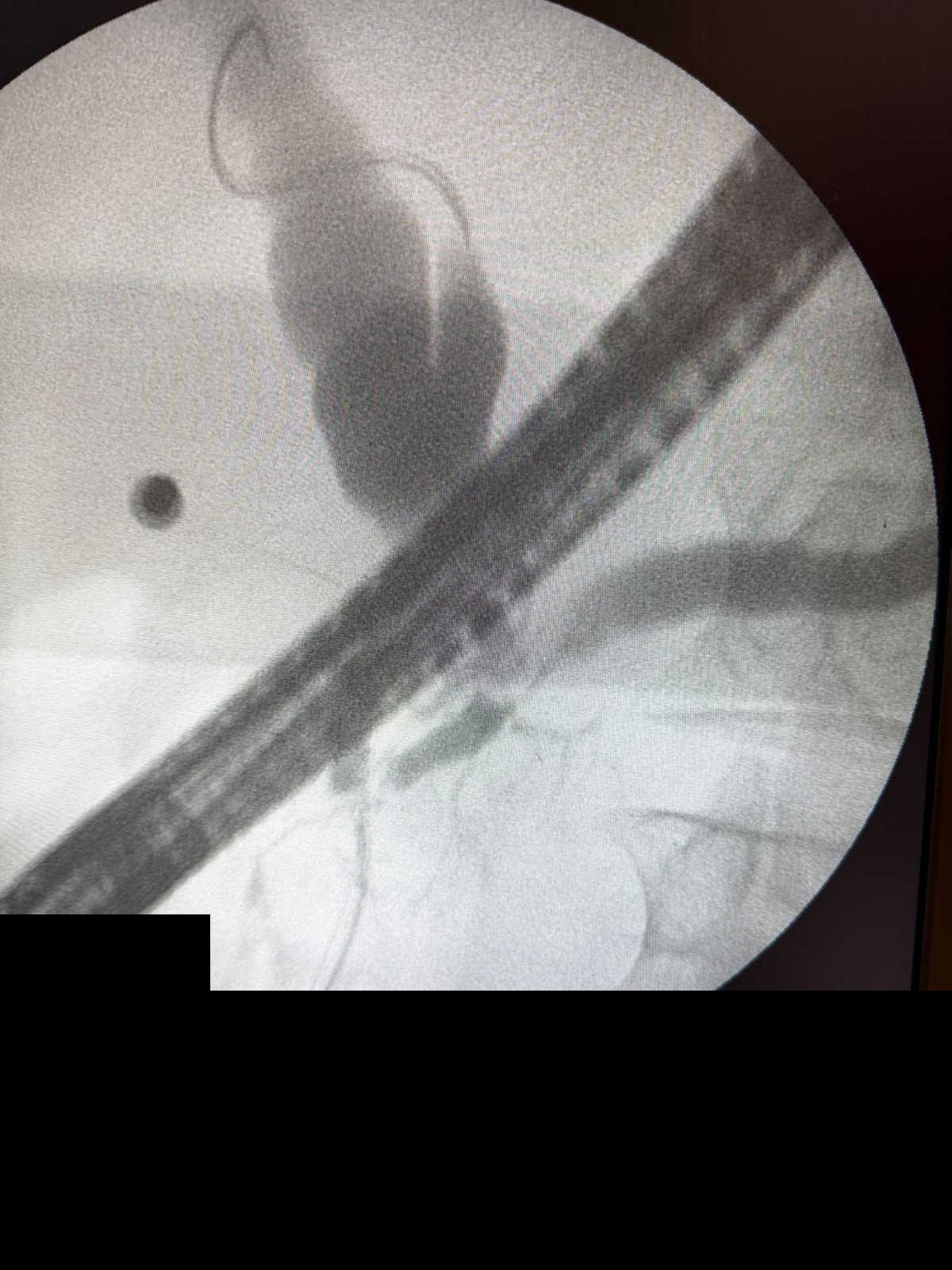 Ercp Fluoroscopy With Sphincterotome And Contrast Outlining Ductal Anatomy