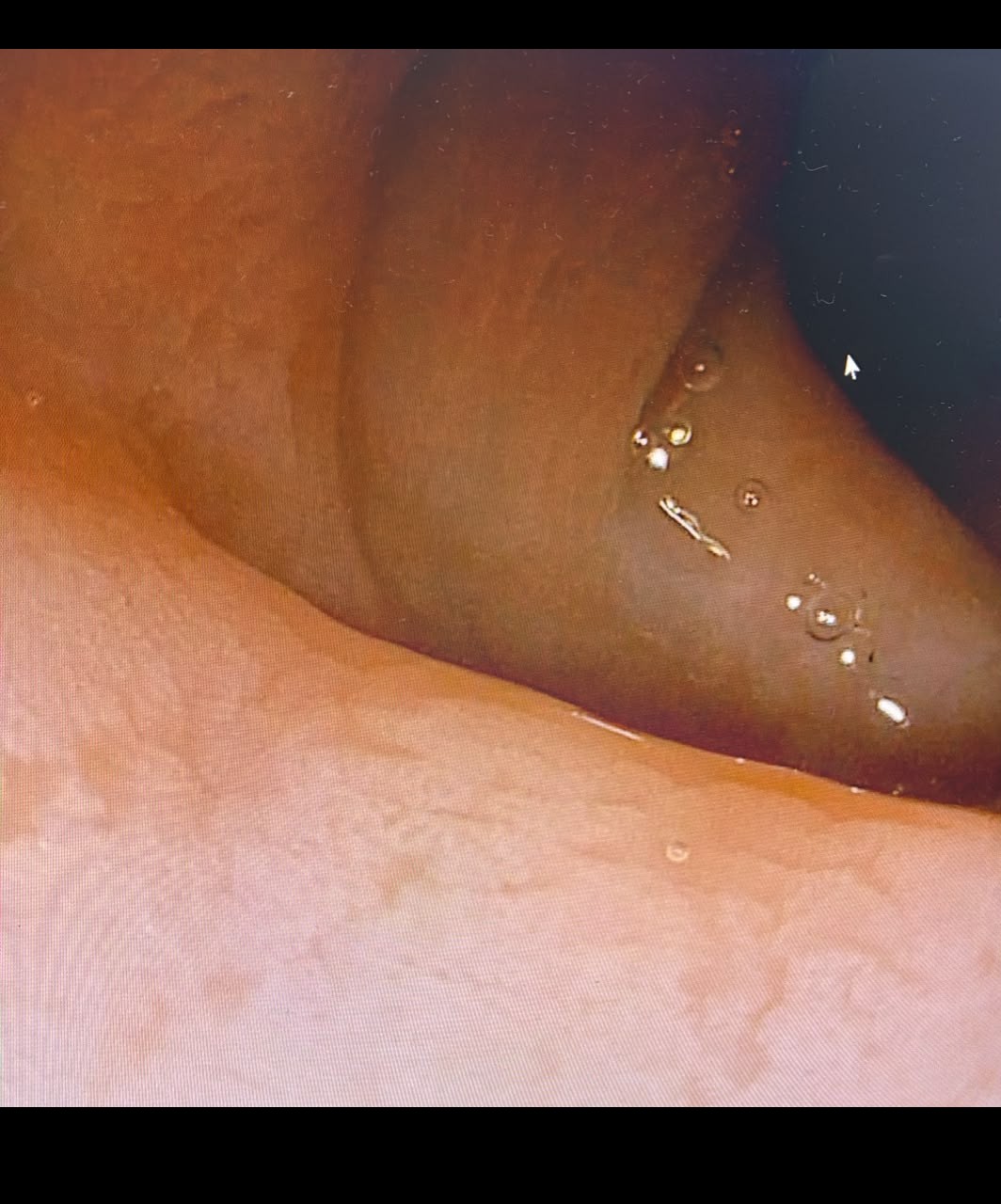 Colonoscopy View Of Segmental Mucosal Change With Whitish Surface Debris