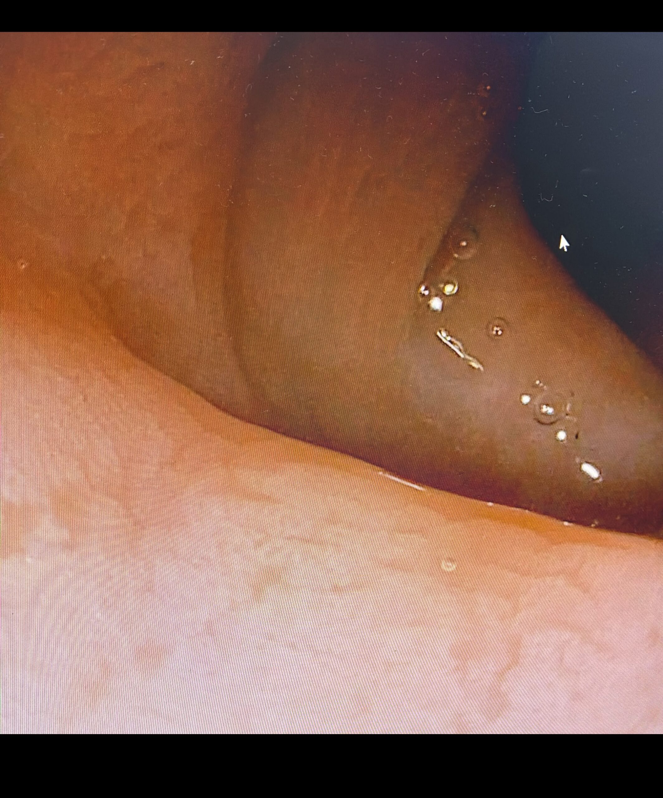 Additional Colonic Segment With Similar Mucosal Injury Pattern