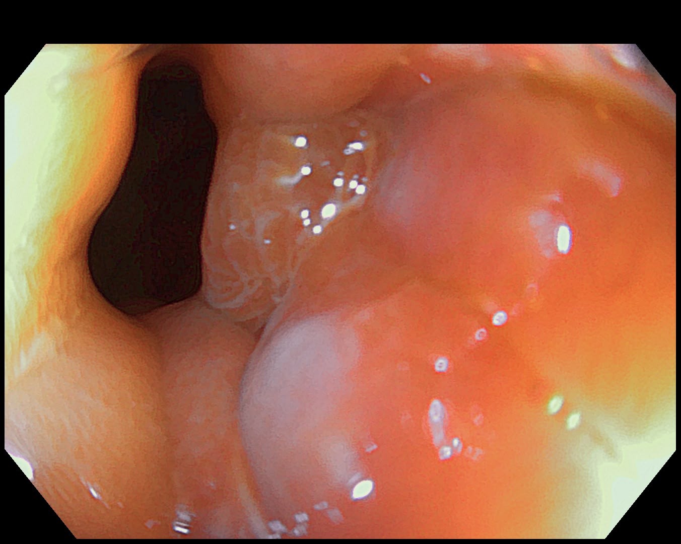 Endoscopic View Of A Polypoid Esophageal Lesion