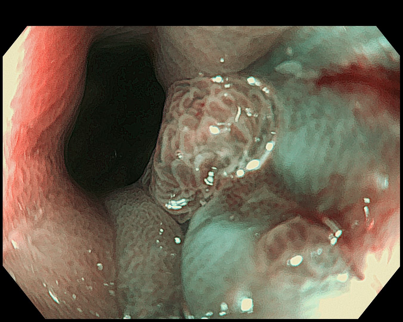 Closer View Of The Esophageal Polyp Surface Pattern