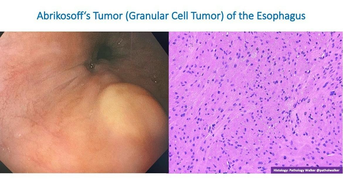 Endoscopic And Histologic Composite Of Esophageal Granular Cell Tumor