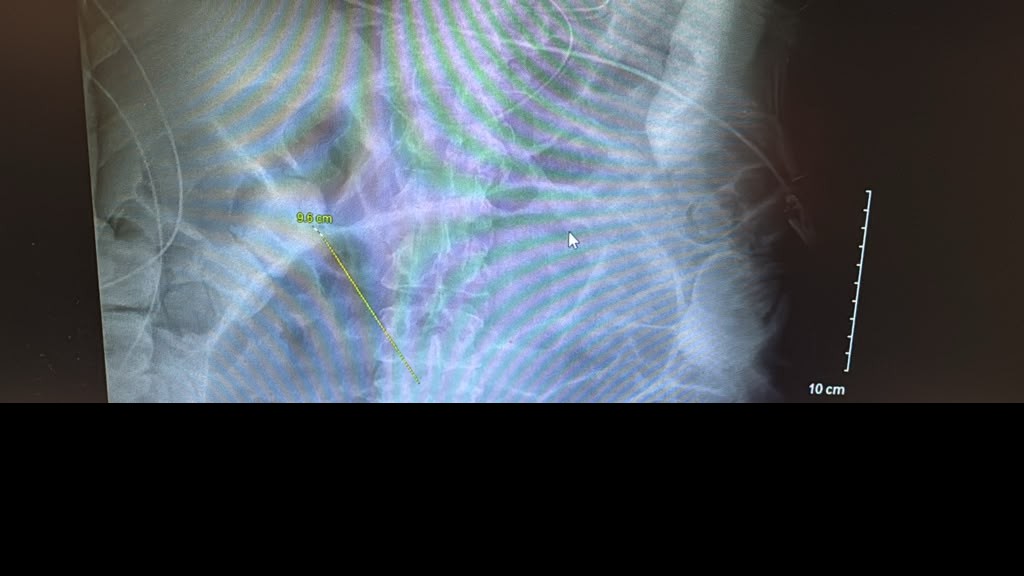 Fluoroscopic Image Showing Markedly Dilated Sigmoid Colon Segment