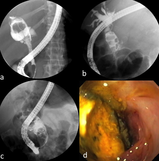 Complex Bile Duct Stones - A Spectrum 11 Complex Bile Duct Stones – A Spectrum
