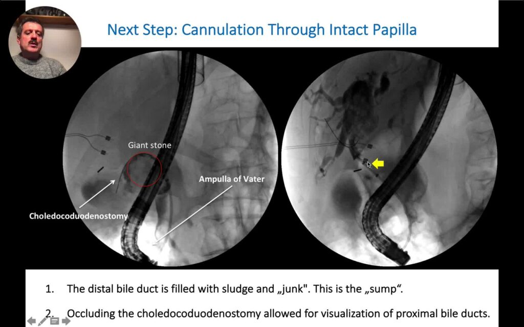 Complex Bile Duct Stones: The Sump Syndrome