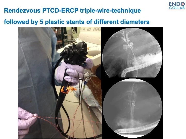 Complex Ischemic Stenosis