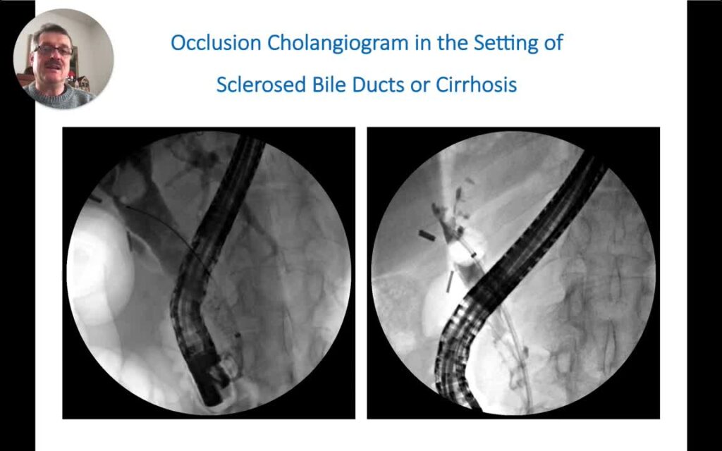 Cpre - Colangiograma De Oclusión 2 Cpre – Colangiograma De Oclusión