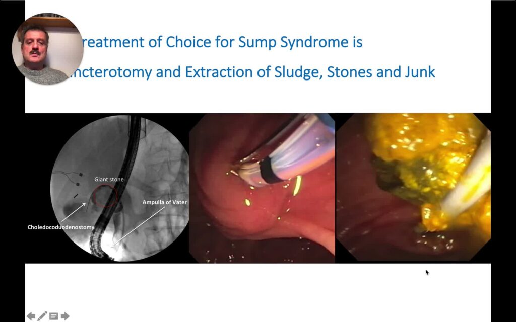 CPRE – Manejo de Lito Difícil – El Síndrome de Letrina (Sump Syndrome)