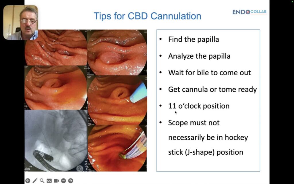 Cpre - Tips Para Canulación De La Vía Biliar 6 Cpre – Tips Para Canulación De La Vía Biliar