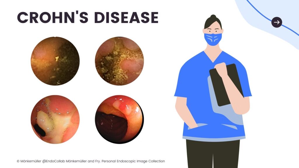 Crohn'S Disease 23 Crohn’s Disease