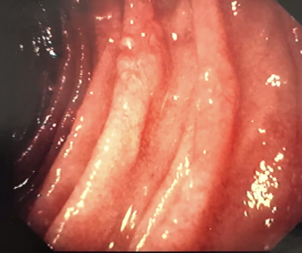 Cytomegalovirus Duodenitis 21 Cytomegalovirus Duodenitis
