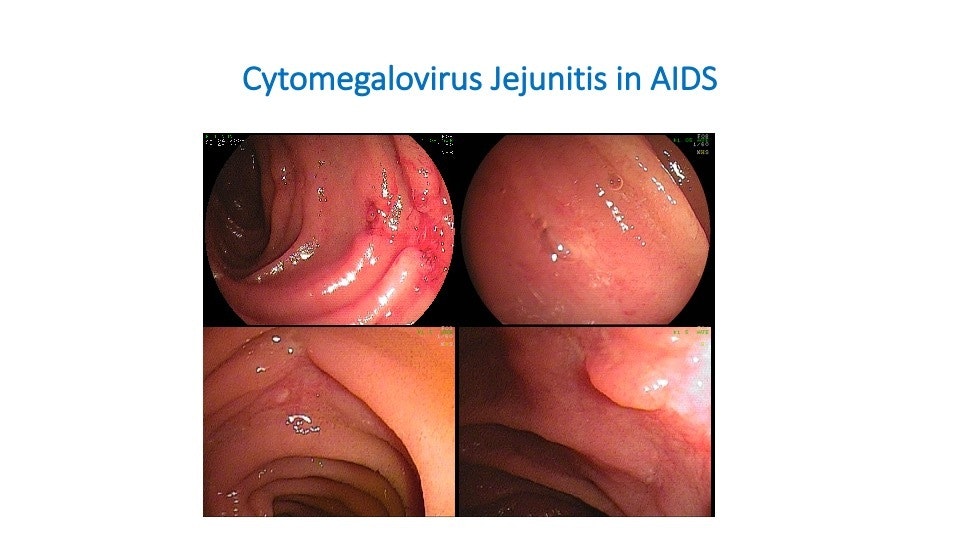 Cytomegalovirus Jejunitis 5 Cytomegalovirus Jejunitis