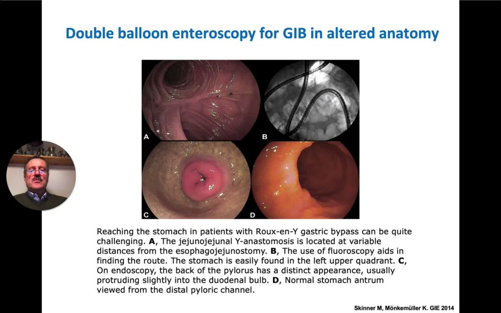 Deep Enteroscopy - New Perspectives 12 Deep Enteroscopy – New Perspectives