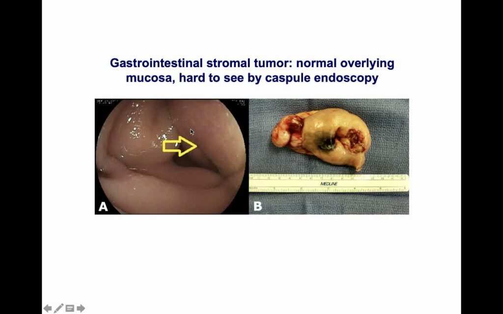 Deep Enteroscopy - Single, Double Or Spiral 7 Deep Enteroscopy – Single, Double Or Spiral