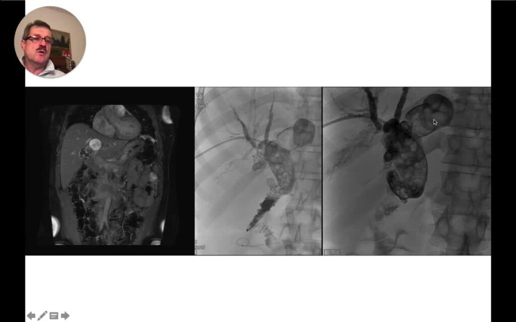 Definition Of Difficult Bile Duct. Based On Stone Size And Shape