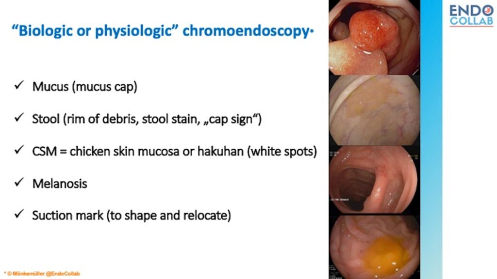 Detecting Colon Polyps Using &Quot;Biologic Chromoendoscopy&Quot; 10 Detecting Colon Polyps Using “Biologic Chromoendoscopy”