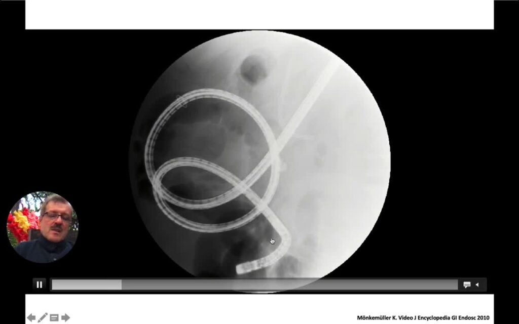 Device-Assited Enteroscopy Ercp