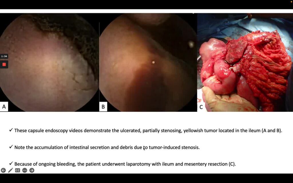 Diffuse B-Cell Lymphoma of the Small Bowel Inducing GI Bleeding and Hemolytic Anemia