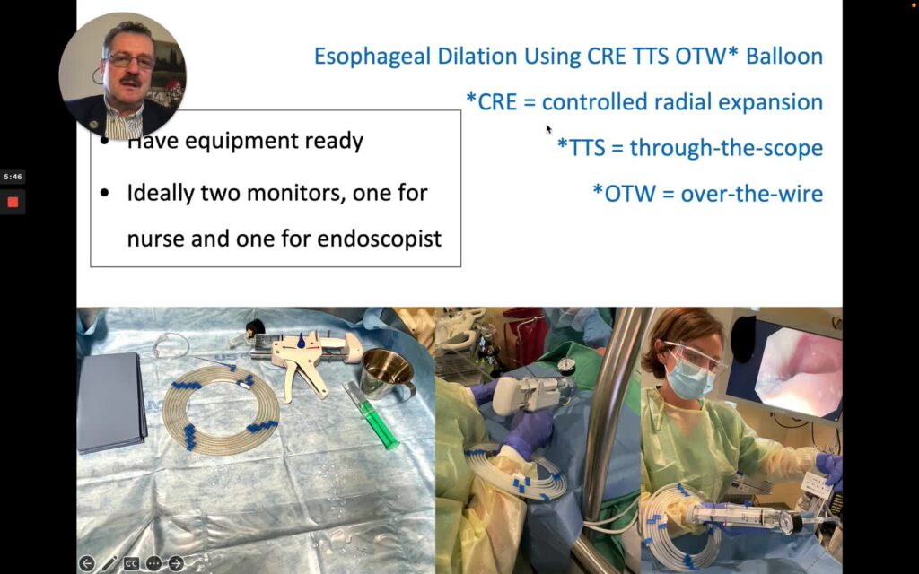 Dilation Of Esophageal Strictures Using Balloons