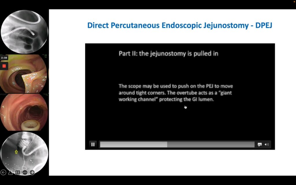 Direct Percutaneous Endoscopic Jejunostomy – Dpej