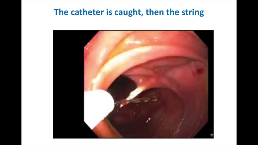 Direct Percutaneous Endoscopic Jejunostomy (Dpej) 9 Direct Percutaneous Endoscopic Jejunostomy (Dpej)