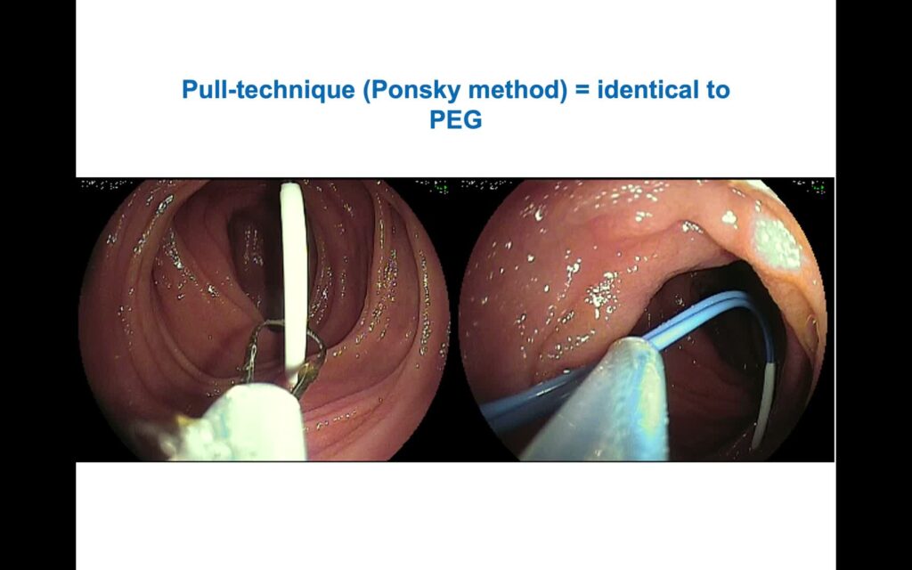 Direct Percutaneous Endoscopic Jejunostomy – In Detail Explanation