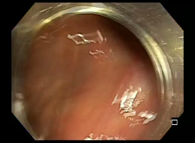 Distal Transparent Caps May Assist In Polyp Detection