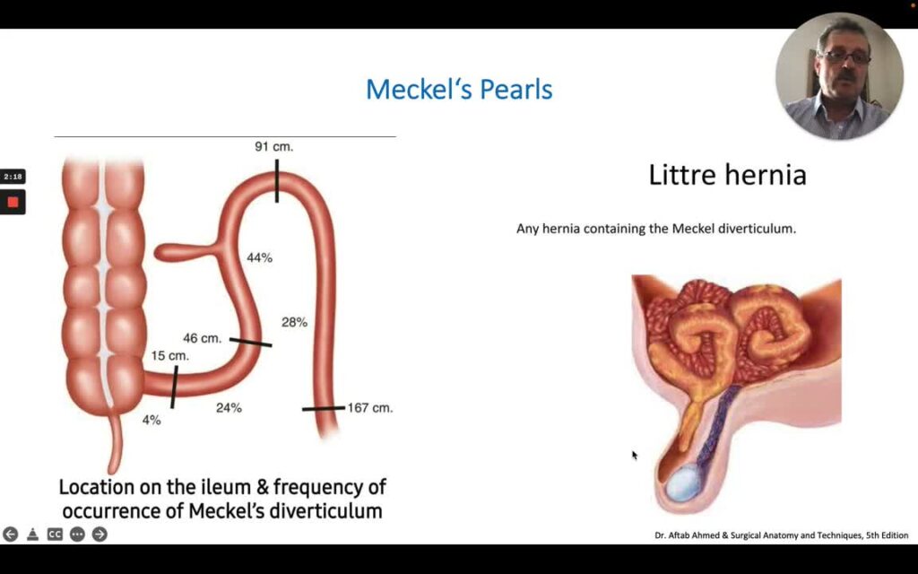 Divertículo De Meckel