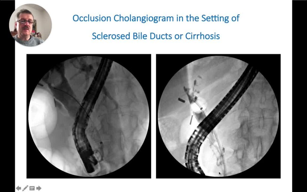 Documenting Stone Clearance: The Occlusion Cholangiogram 4 Documenting Stone Clearance: The Occlusion Cholangiogram
