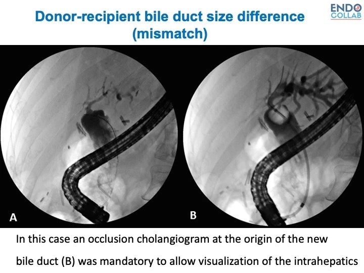 Donor-Recipient Bile Duct Size Mismatch 17 Donor-Recipient Bile Duct Size Mismatch