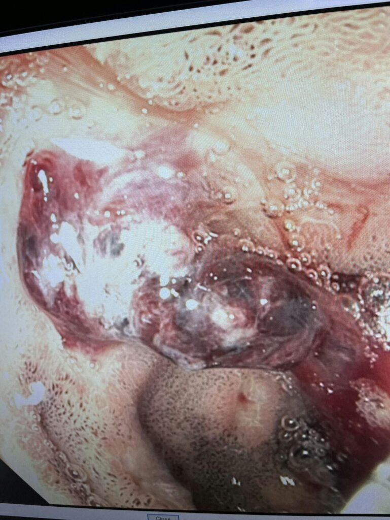 Duodenal Bulb Cratered Ulcer With An Overlying Clot (Removed) And Underlying Large Visible Vessel By Ramzi Mulki
