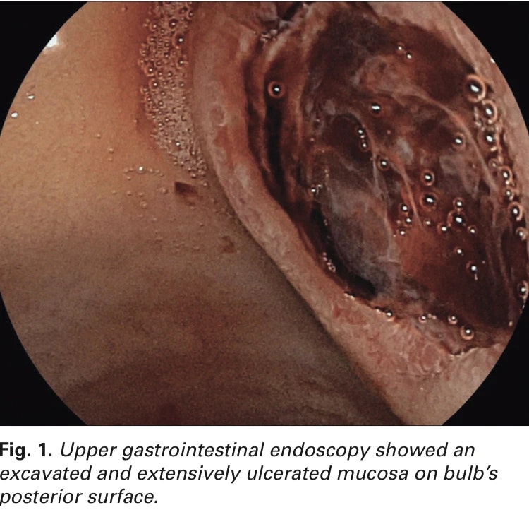 Duodenal Ulcer Bleeding: When Therapeutic Endoscopy Does Not Have Any Role
