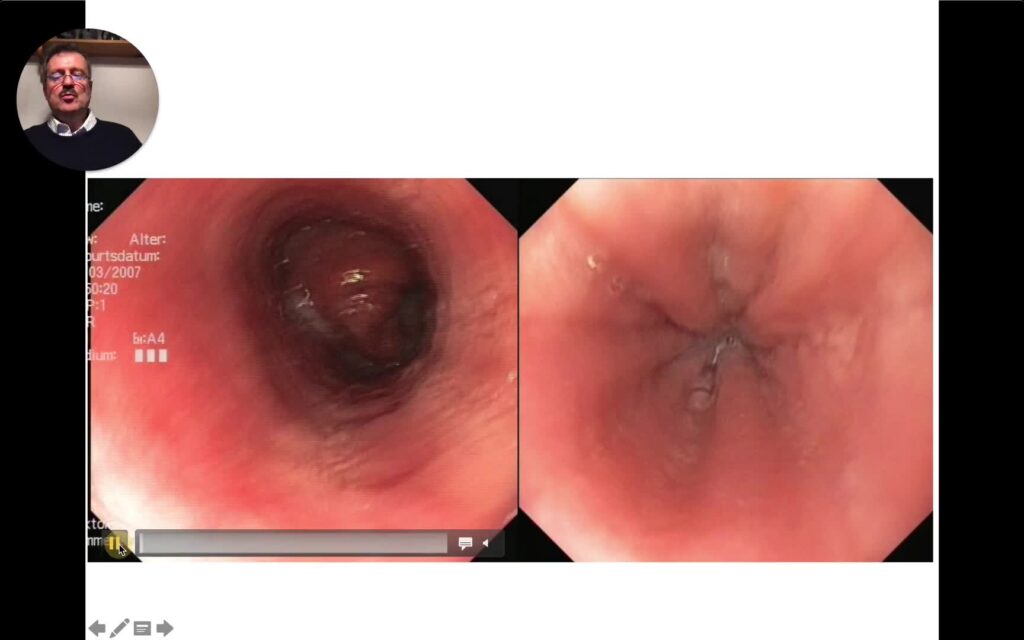 Dysphagia And Odynophagia – An Endoscopic Atlas