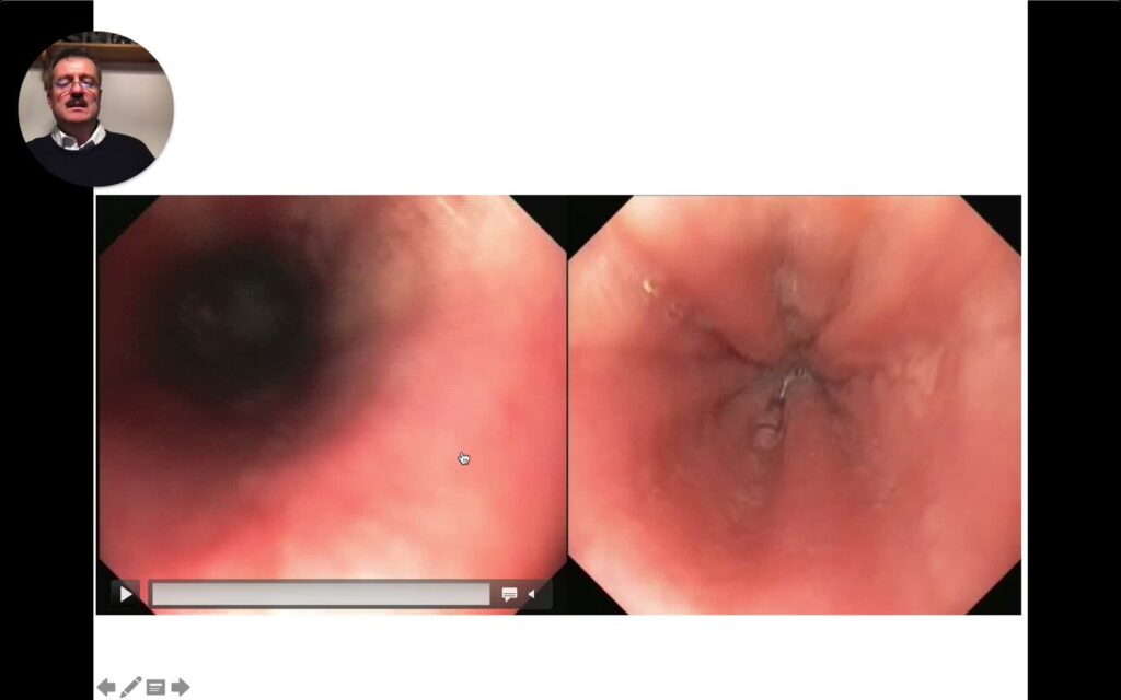 Dysphagia And Odynophagia: An Endoscopic Atlas With Diagnostic Tips 9 Dysphagia And Odynophagia: An Endoscopic Atlas With Diagnostic Tips
