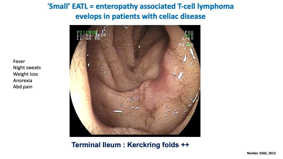 Eatl - Enteropathy-Associated T-Cell Lymphoma Associated With Celiac Disease 1 Eatl – Enteropathy-Associated T-Cell Lymphoma Associated With Celiac Disease