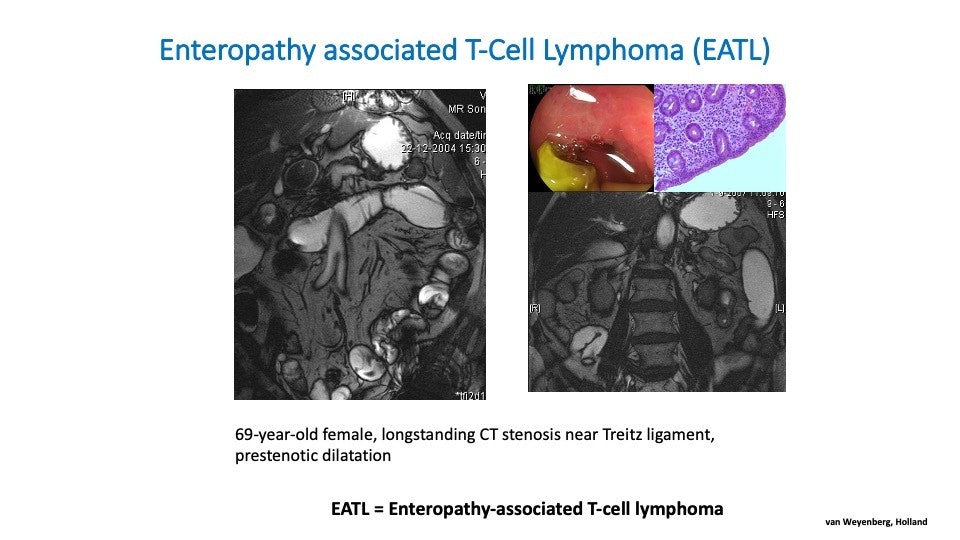 Eatl – Enteropathy-Associated T-Cell Lymphoma Associated With Celiac Disease, Part 2