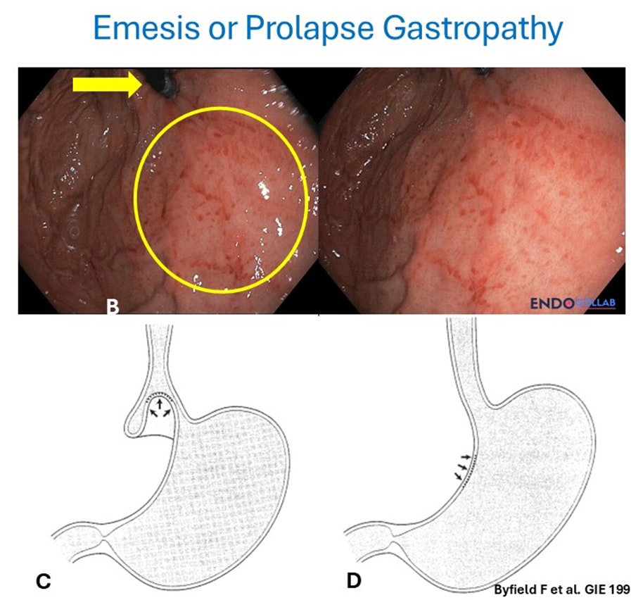 Emesis Or Prolapse Gastropathy