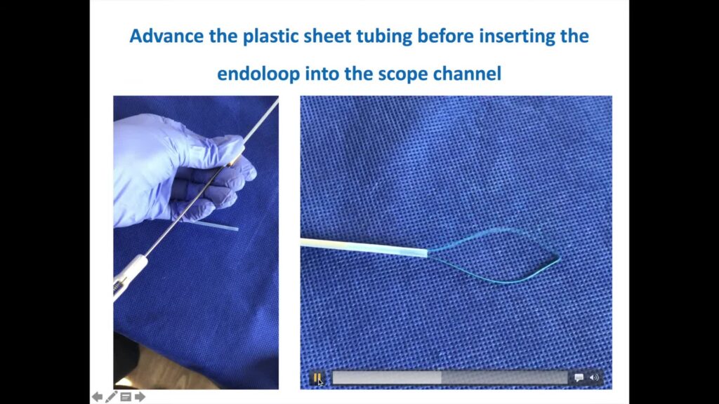 Endoloops In Gi Endoscopy